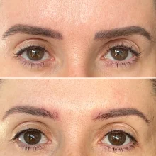 before-after-3-glycolic-acid-removal-sessions-brisbane-qld-v0-cjrm8amkdtdd1